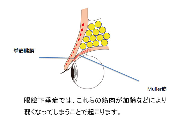 眼瞼下垂症