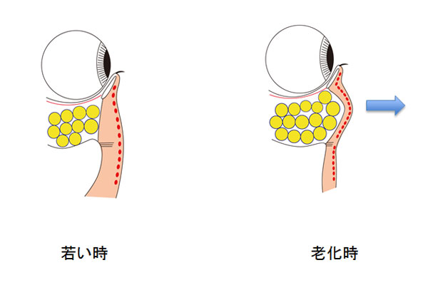 下眼瞼の老化のメカニズム