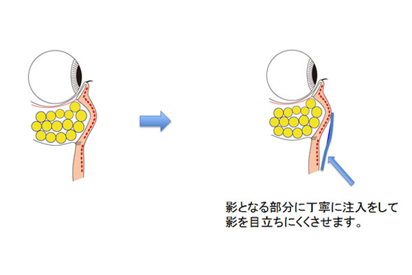 注入で影を目立ちにくくさせる方法