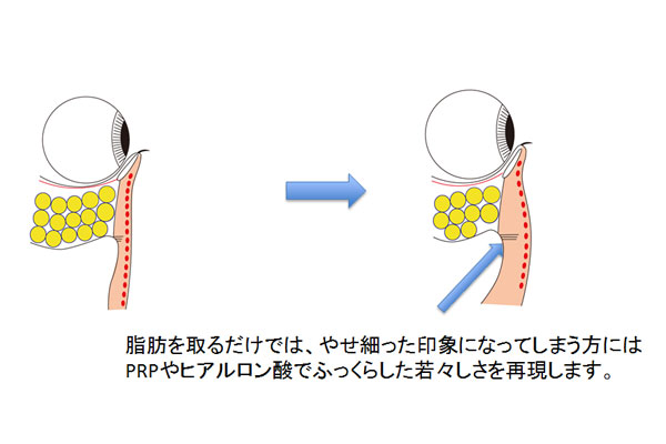 経結膜脱脂にヒアルロン酸や脂肪注入併用