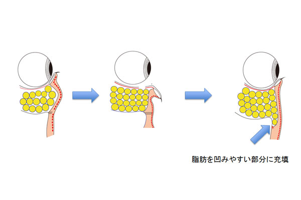 経結膜Hamra法