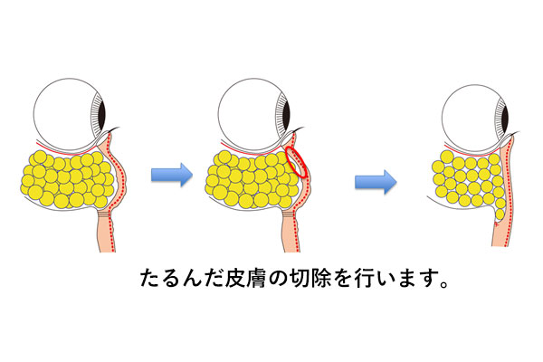 Hamra法