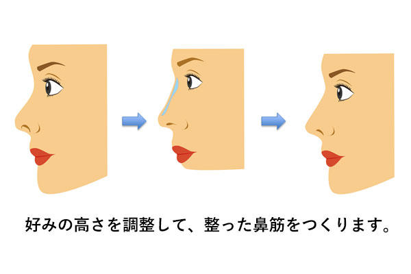 インプラントによる隆鼻術