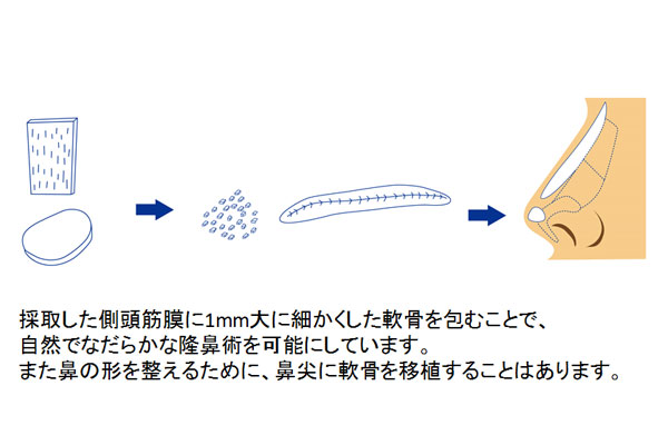 軟骨を1mm大にして、筋膜で丸めて、鼻に挿入して隆鼻に利用