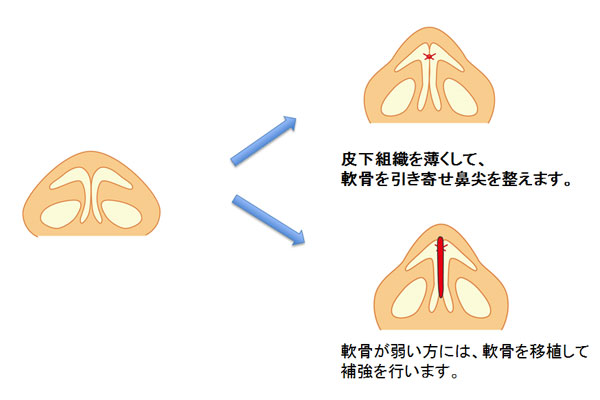 スタンダード鼻尖形成