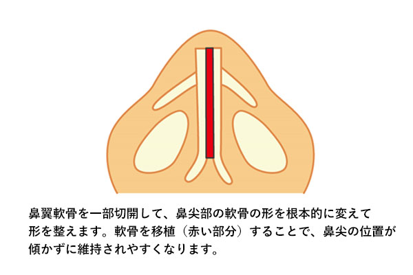 Turdy法（３D法）