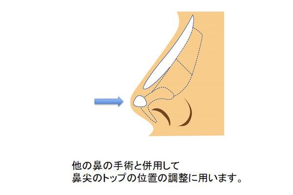 鼻尖軟骨移植