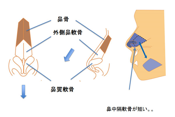 鼻中隔延長術