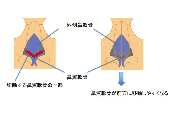 鼻中隔軟骨と一緒に鼻翼軟骨が前方に移動