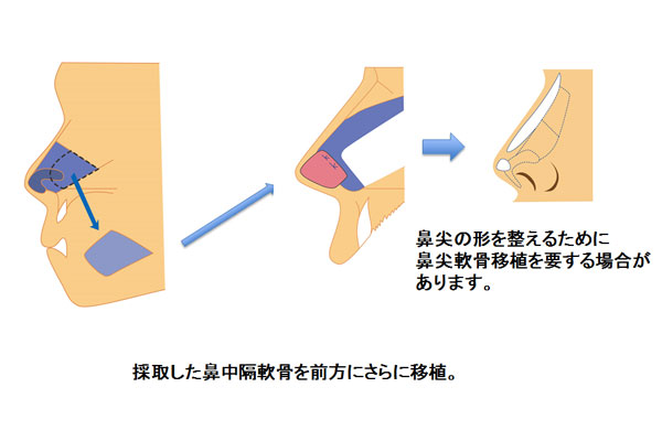 採取した鼻中隔軟骨を前方へさらに移植