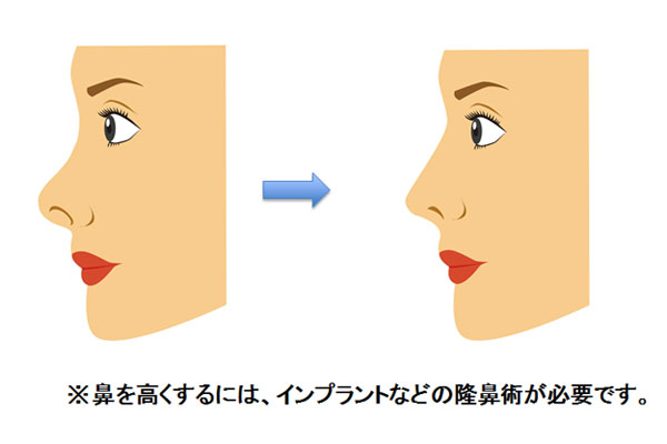 鼻を高くするには、インプラントなどの隆鼻術が必要