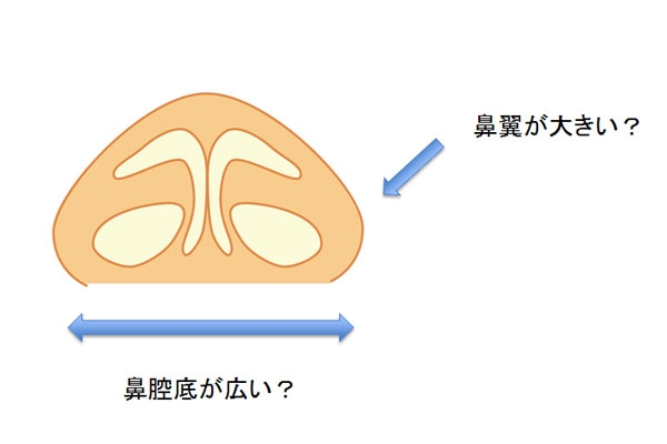 鼻の横幅が大きい方のバランスを整える