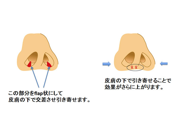 鼻腔底短縮術(flap法)