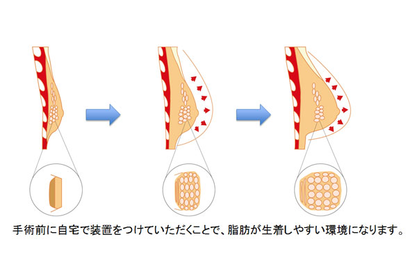 手術前から自宅で胸に装着で生着率が大きく上昇