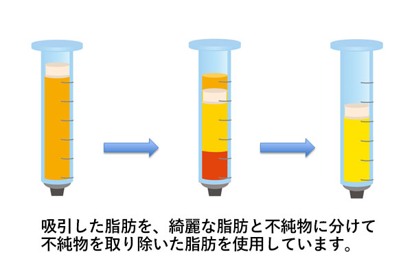 不純物を取り除き、高品質な脂肪にした上で注入