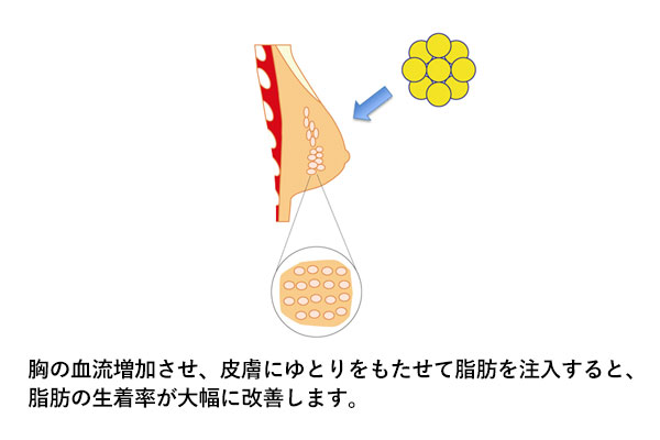 安定的な脂肪の生着