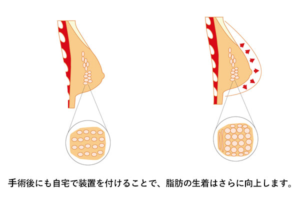 手術後にも装置をつけることで脂肪の生着は大幅に増大