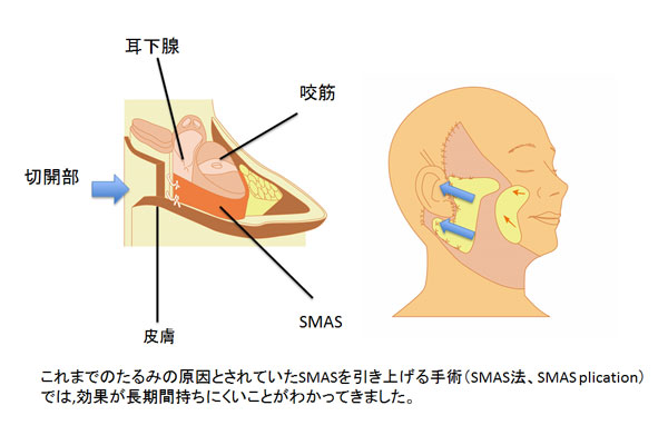 これまでのフェイスリフトはSMASというたるみの原因とされる膜を単純に引き上げる手術では効果が長期間持ちにくい