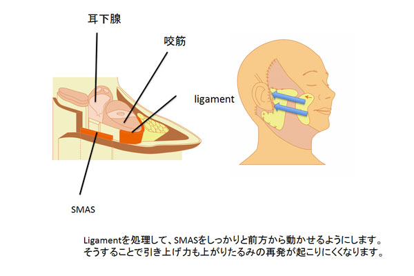 ligamnntを処理して、SMASをしっかり前方から動かせるようにします。それにより引き上げ力も上がり再発が起こりにくくなります