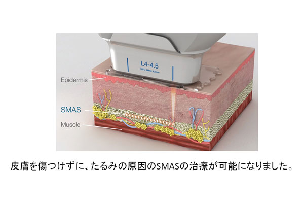 切らないフェイスリフトHIFU