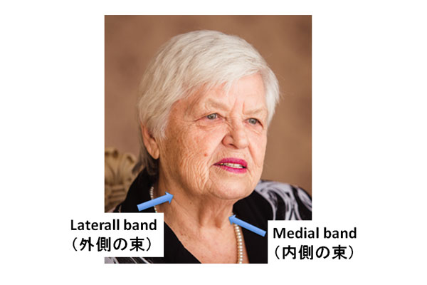 Laterall band（外側の束）とMedial band（内側の束）