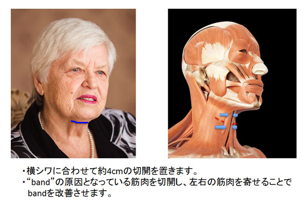 medial neck lift