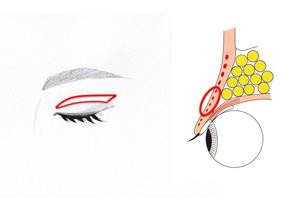 上眼瞼皮膚切除術