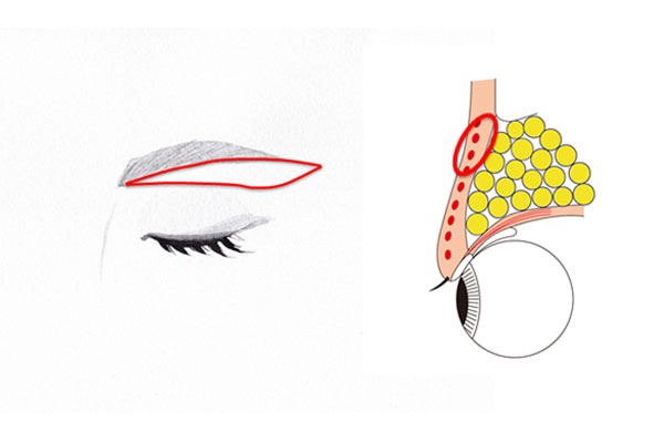 眉毛下切除術
