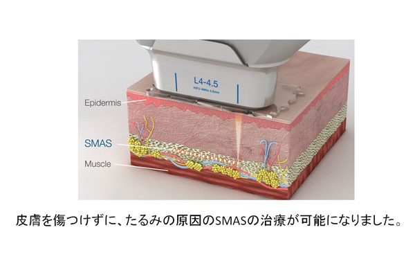 p351_600_400 切らない最強のリフトアップ(HIFU)