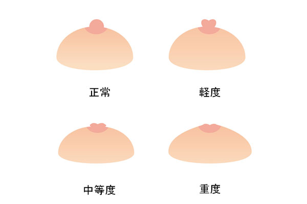 乳頭 は 陥没 と 陥没乳頭（陥没乳首）の手術｜日本医科大学武蔵小杉病院