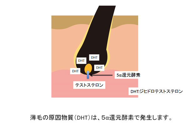 薄毛の原因