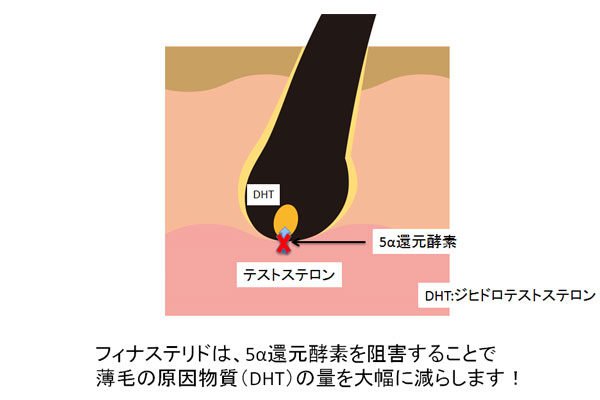 フィナステリド