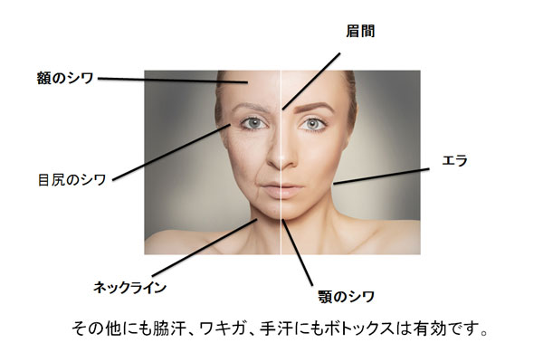 最適なボトックス治療提案