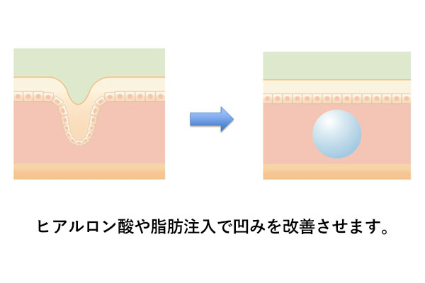 ヒアルロン酸や脂肪注入で大ジワを改善する