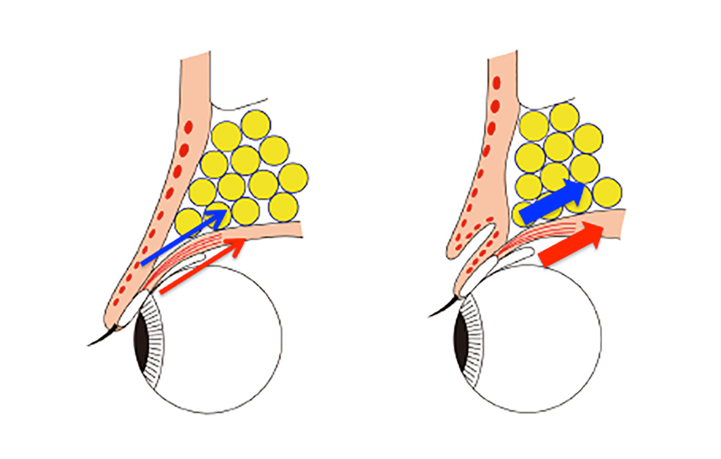 眼瞼下垂とは
