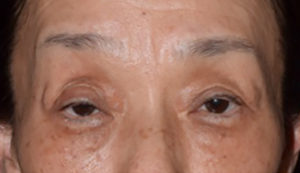 眼瞼下垂のサイン