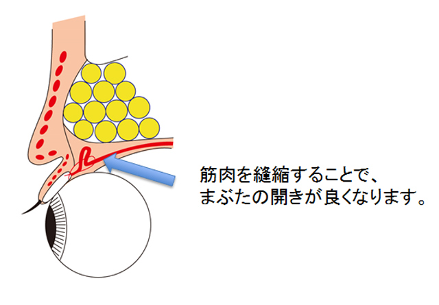 筋肉の短縮