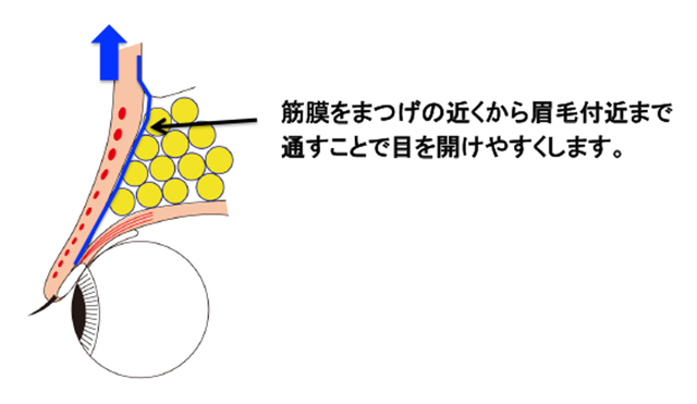 筋膜の移植