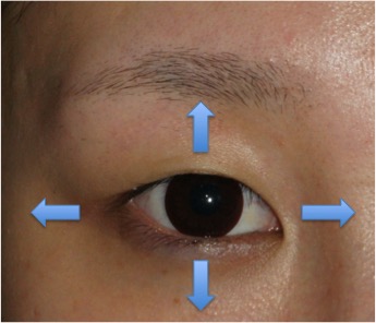 目を大きくするには 眼瞼下垂 目頭切開 目尻切開 たれ目形成