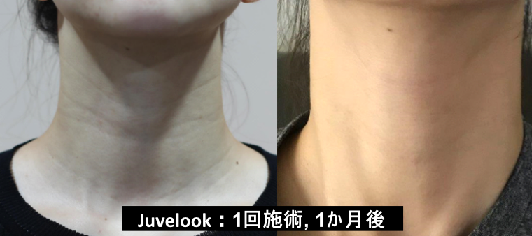 Juvelook_neck_wrinkles